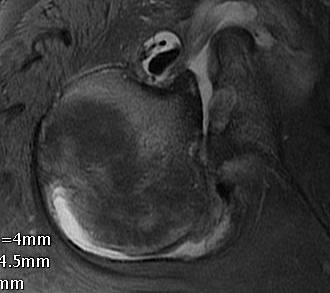 Chronic Posterior Shoulder Dislocation MRI Axial